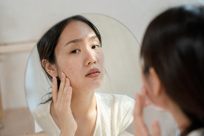 Post-Breakout Marks vs Dark Spots: How to Care for Uneven Tone Without Overdoing Actives