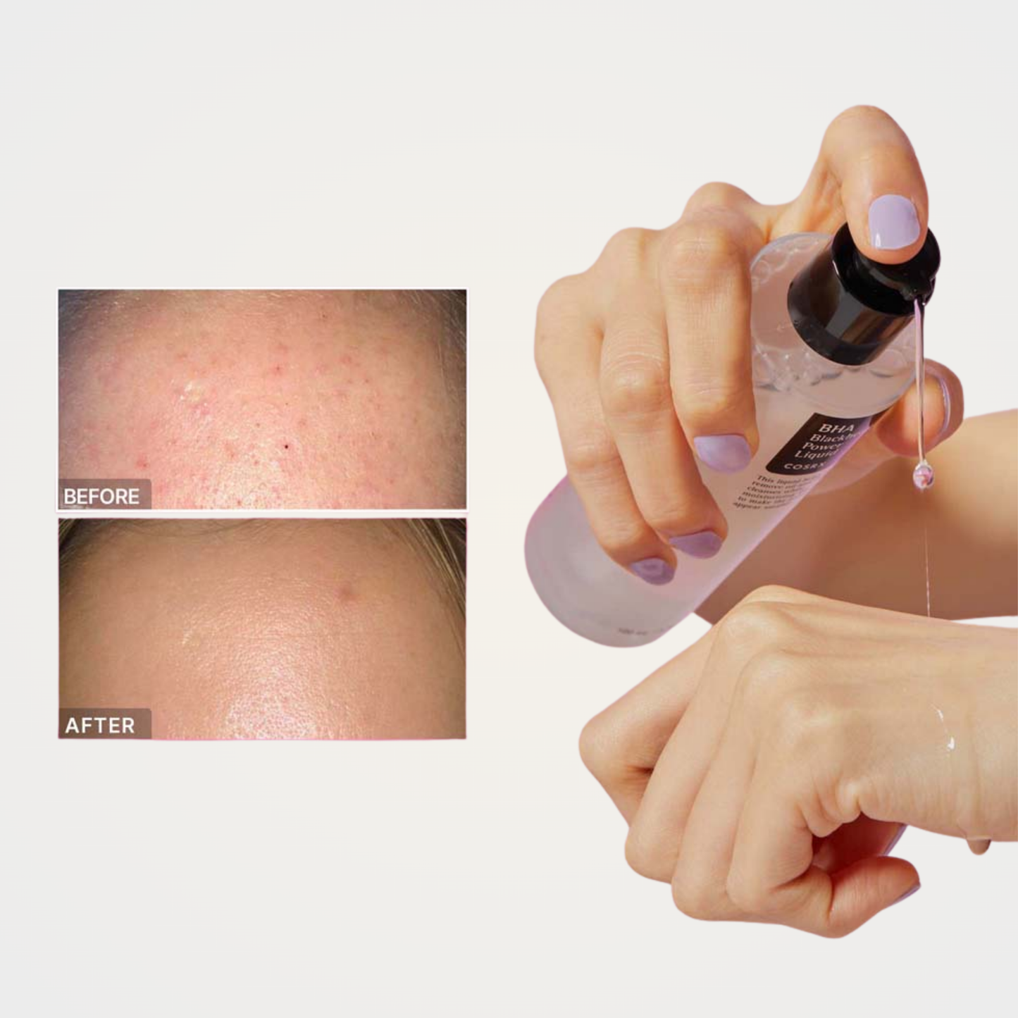 Before and after results with COSRX BHA Blackhead Power Liquid – visibly reduced blackheads and smoother skin.